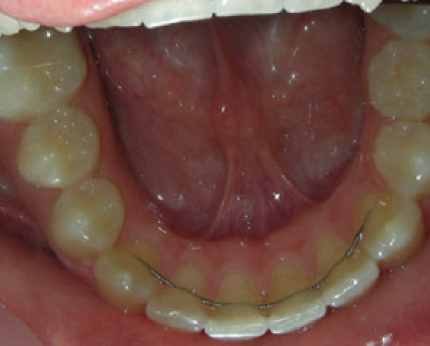La contention post-orthodontique
